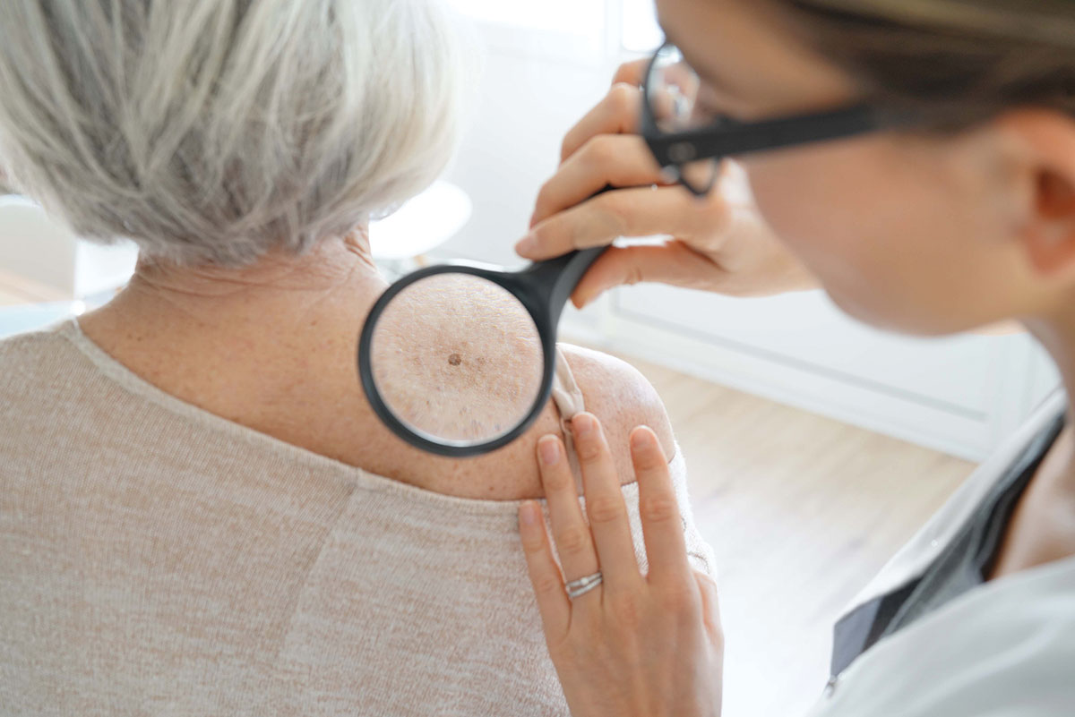 Is Skin Cancer Hereditary?